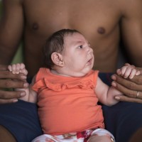 The Zika virus is strongly believed to be the cause of a massive increase in reported cases of microcephaly – underdevelopment of the brain in babies leading to an abnormally small cranium