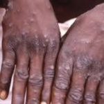 mpox in sub-Saharan Africa